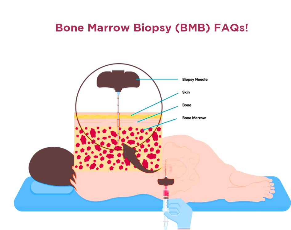 bone marrow transplant pain